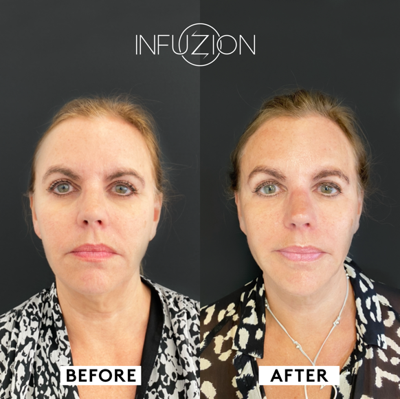 Infuzion Volymizer före och efter – Helena
